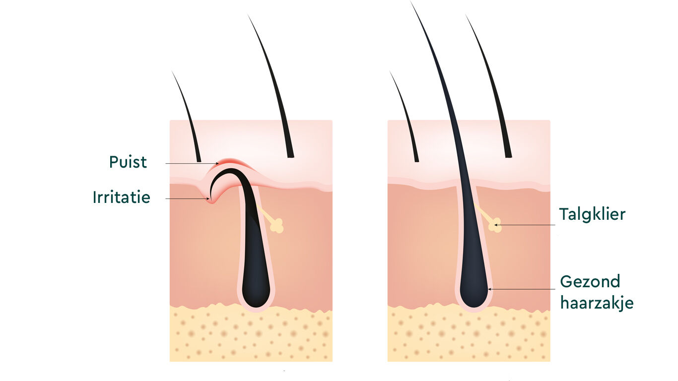 Illustration: Comparison of a cross-section of skin showing an ingrown hair versus a healthy hair. 